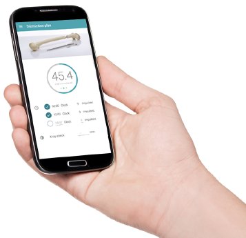 02_WITTENSTEIN_FITBONE_App_Smartphone.png