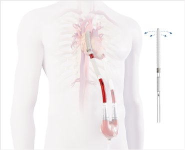 EXCOR® Graft Cannula: The new flexibility of graft anastomosis