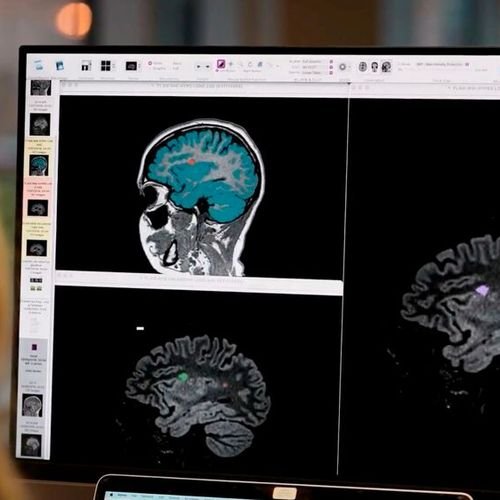 Entschlüsselung der Parkinson-Krankheit durch KI und Cloud