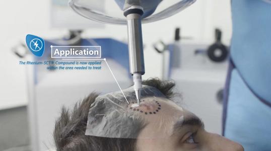 Application technique OncoBeta