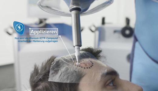 Applikationstechnik OncoBeta