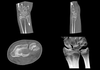 DVT-Aufnahme eines kindlichen Handgelenks nach einem Sturz – Spezielle Low Dose-Protokolle reduzieren die Strahlenbelastung signifikant und ohne Verlust an Bildaussagekraft.