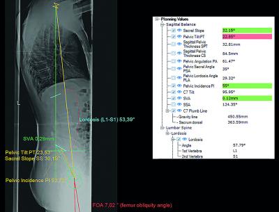 Determination of Sagittal Balance