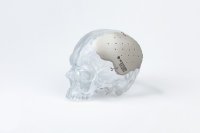 3D-printed patient specific PEEK Cranial Implant