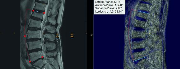 Digital planning based on MRI images