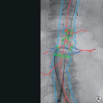 Endovascular Navigation_1.jpg