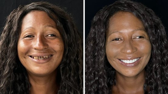 CORP-Press-image-Project-32-patient-before-after.jpg
