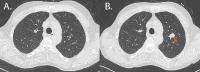 59-jähriger Raucher mit 30 Packungsjahren, Teilnehmer der deutschen LUSI-Studie (Lung Tumor Screening and Intervention). A. Baseline-Untersuchung ohne Rundherd, B. Ein-Jahreskontrolle: neuer 15 mm Rundherd (↑). Die Histologie ergab ein schlecht differenziertes Adenokarzinom, (pT1b), 5 Jahre später war der Patient weiterhin tumorfrei