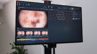 Binnen weniger Augenblicke ordnet die Software eine Hautläsion mit dem KI-Score ein.